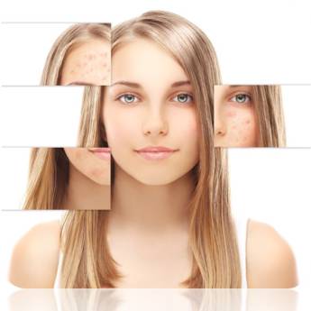 Comprar o produto de Tratamento de Acne – Controle e Renovação da Pele em São Paulo/SP em Clínicas de Estética e Beleza em São Paulo, SP por Solutudo