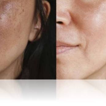 Comprar o produto de Tratamento para Eliminação de Manchas – Pele Uniforme e Radiante em São Paulo/SP em Clínicas de Estética e Beleza em São Paulo, SP por Solutudo