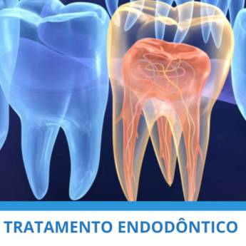 Comprar produto Tratamento Endodôntico em Endodontia pela empresa Clínica Mário Munhoz em Itapetininga, SP