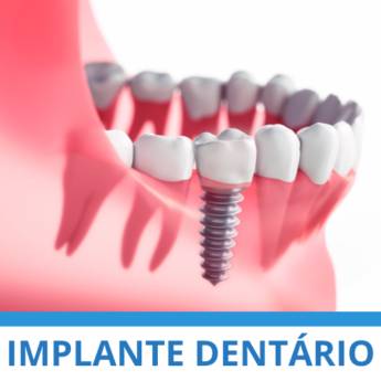 Comprar produto Implante Dentário em Odontologia pela empresa Clínica Mário Munhoz em Itapetininga, SP