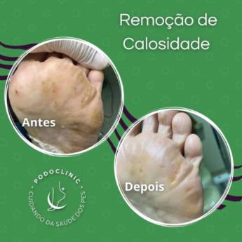 Comprar o produto de Remoção Calos e calosidades em Podologia em Itaitinga, CE por Solutudo