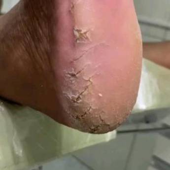 Comprar o produto de Remoção de fissuras em Podologia em Itaitinga, CE por Solutudo