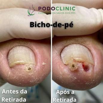 Comprar o produto de Remoção de Bicho de pé em Podologia em Itaitinga, CE por Solutudo
