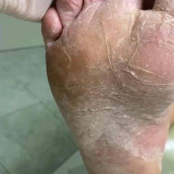 Comprar o produto de Esfoliação em Podologia em Itaitinga, CE por Solutudo