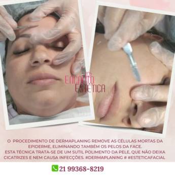 Comprar o produto de  Dermaplaning: A Esfoliação Profunda para uma Pele Radiante no Rio de Janeiro/RJ em Clínicas de Estética e Beleza pela empresa Encanto Estética em Rio de Janeiro, RJ por Solutudo
