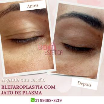 Comprar o produto de Blefaroplastia: Rejuvenesça Seu Olhar no Rio de Janeiro/RJ em Clínicas de Estética e Beleza pela empresa Encanto Estética em Rio de Janeiro, RJ por Solutudo