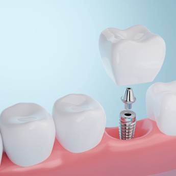 Comprar o produto de Implantes em Odontologia em Botucatu, SP por Solutudo