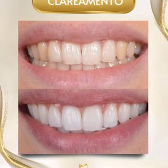 Comprar o produto de Clareamento em Odontologia em Fortaleza, CE por Solutudo