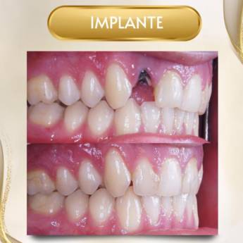 Comprar o produto de Implante Dentário em Odontologia em Fortaleza, CE por Solutudo