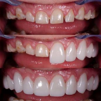 Comprar o produto de Recuperação Dentária em Odontologia em Fortaleza, CE por Solutudo