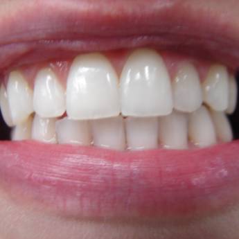 Comprar o produto de Clareamento Dental em Odontologia em Resende, RJ por Solutudo