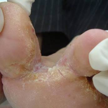 Comprar o produto de Tínea pedis - Fieira em Podologia em Aracaju, SE por Solutudo