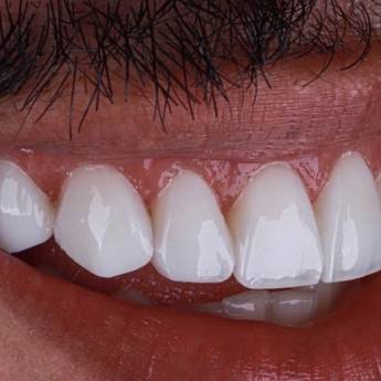 Comprar o produto de Facetas em Resina em Odontologia em Botucatu, SP por Solutudo