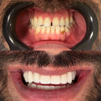 Comprar o produto de Facetas em Odontologia em Botucatu, SP por Solutudo