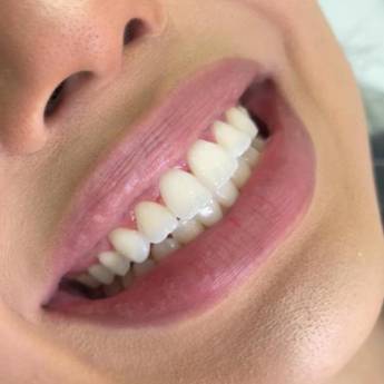 Comprar o produto de Clareamento em Odontologia em Botucatu, SP por Solutudo