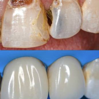 Comprar o produto de Restauração em Odontologia em Botucatu, SP por Solutudo