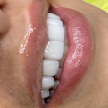 Comprar o produto de Lentes Contato Dentais em Odontologia em Barueri, SP por Solutudo