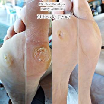 Comprar o produto de Verruga Plantar em Podologia em Botucatu, SP por Solutudo