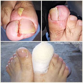 Comprar o produto de Unha Encravada em Podologia em Botucatu, SP por Solutudo