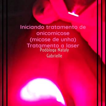 Comprar o produto de Laserterapia em Podologia em Botucatu, SP por Solutudo