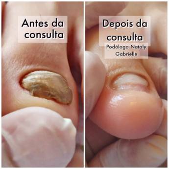 Comprar o produto de Micose de unha em Podologia em Botucatu, SP por Solutudo