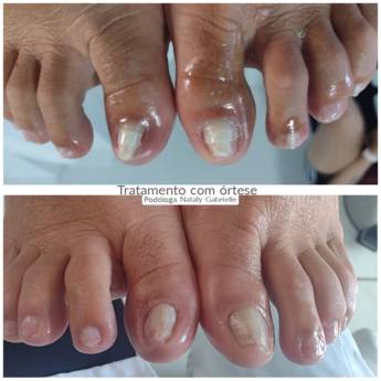 Comprar o produto de Fibra de Memória em Podologia em Botucatu, SP por Solutudo