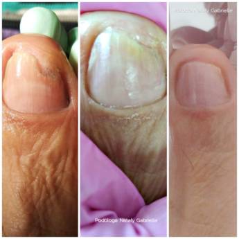 Comprar o produto de Tratamento de Onicomicose com Laserterapia em Podologia em Botucatu, SP por Solutudo