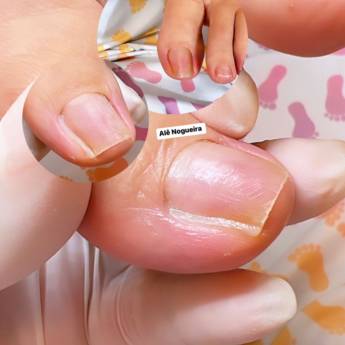 Comprar o produto de Tratamento de Unhas Encravadas em Podologia em São Paulo, SP por Solutudo
