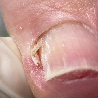 Comprar o produto de Onicofose  em Podologia em São Paulo, SP por Solutudo