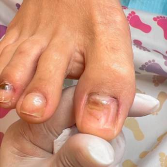 Comprar o produto de Trauma Ungueal em Podologia em São Paulo, SP por Solutudo