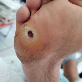 Comprar o produto de Tratamento de Pé diabético em Podologia em São Paulo, SP por Solutudo