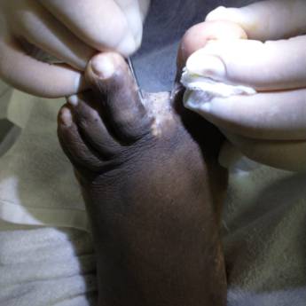 Comprar o produto de Frieira  em Podologia em São Paulo, SP por Solutudo