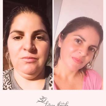 Comprar o produto de Lipo de Papada em Clínicas de Estética e Beleza em Bertioga, SP por Solutudo