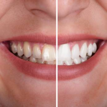 Comprar o produto de Clareamento dental em Odontologia em Vinhedo, SP por Solutudo