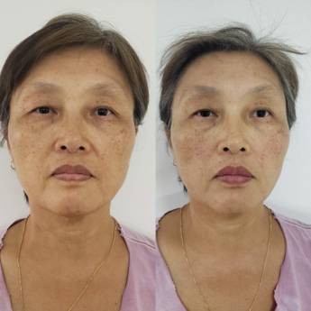 Comprar o produto de Toxina botulínica (botox) em Bauru em Estética Facial em Bauru, SP por Solutudo