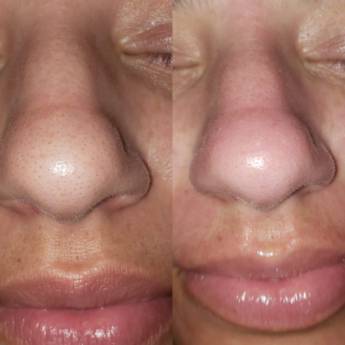 Comprar o produto de Limpeza de Pele em Bauru em Estética Facial em Bauru, SP por Solutudo