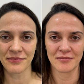 Comprar o produto de Botox em Jundiaí - BOTOX BOOST BSI em Clínicas de Estética e Esteticistas em Jundiaí, SP por Solutudo