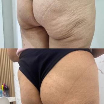 Comprar o produto de Harmonização dos Glúteos em Jundiaí - GLÚTEOS POWER LIFT em Clínicas de Estética e Esteticistas em Jundiaí, SP por Solutudo
