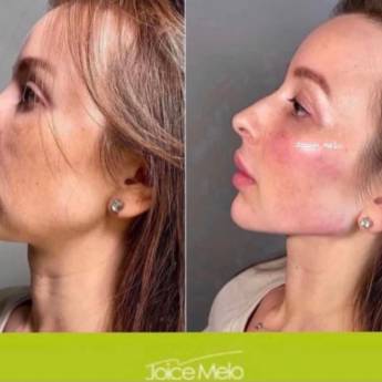 Comprar o produto de Preenchimento facial em Estética Facial em Mineiros, GO por Solutudo