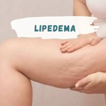 Comprar o produto de Tratamento para Lipedema (Gordura nas pernas) em Tratamentos em Botucatu, SP por Solutudo