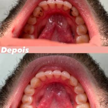 Comprar o produto de Profilaxia- Limpeza dentária  em Odontologia em Mineiros, GO por Solutudo