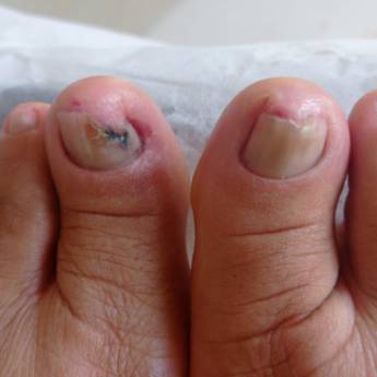 Comprar o produto de Tratamento de Onicomicose em Franca: Soluções Eficazes - Clínica Roseli Rosendo em Podologia em Franca, SP por Solutudo