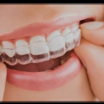 Comprar o produto de Aparelho Invisível Ortodontia - Liberte-se do Sorriso Metálico - Macatuba em Odontologia em Macatuba, SP por Solutudo