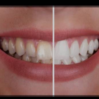 Comprar o produto de Clareamento - Indolor, Seguro e Rápido - Macatuba em Odontologia em Macatuba, SP por Solutudo