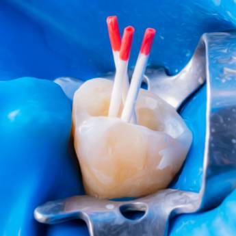 Comprar o produto de Retratamento de Canal em Niterói: Reabilitação Precisa e Confiável em Odontologia em Niterói, RJ por Solutudo