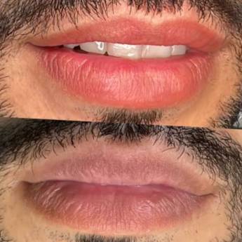 Comprar o produto de Revitalização Labial em Revitalização labial em Mineiros, GO por Solutudo
