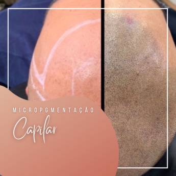 Comprar o produto de Micropigmentação capilar em Profissionais de Beleza em 4º Centenário, PR por Solutudo