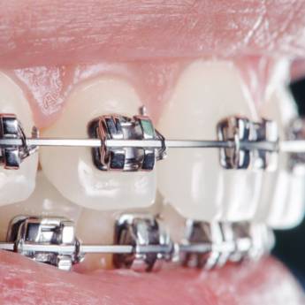 Comprar o produto de Aparelhos Ortodônticos – Sorriso Alinhado e Saúde Bucal em Lençóis Paulista/SP em Ortodontia em Lençóis Paulista, SP por Solutudo