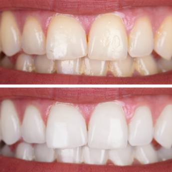 Comprar o produto de Clareamento Dentário – Sorriso Mais Branco e Confiante em Lençóis Paulista/SP em Clareamento em Lençóis Paulista, SP por Solutudo