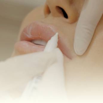 Comprar o produto de Preenchimento labial em Estética Facial em Foz do Iguaçu, PR por Solutudo